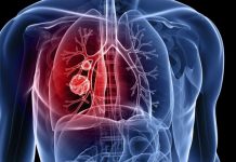 Cele mai frecvente CINCI tipuri de cancer si simptomele acestora
