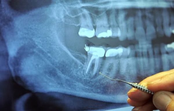 Important! 97% dintre pacientii care sufera de cancer au fost supusi acestei proceduri stomatologice!