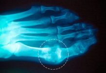 Guta si dureri articulare – Iata cum poti scapa de cristalele de acid uric prezente la nivelul incheieturilor!