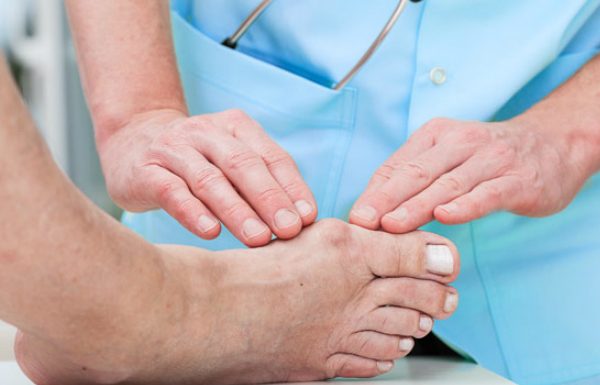 Tratament pentru monturi! Medicii numesc aceasta problema “hallux valgus”