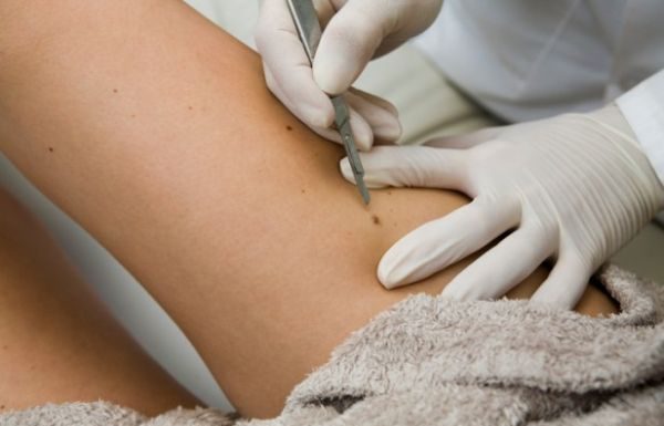 Alunita normala sau melanom – Un renumit medic ne prezinta un sistem prin care putem face diferenta dintre cele doua!